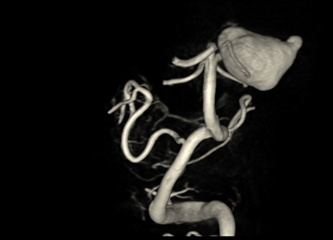 The aneurysm that was discovered in the brain. Credit: Shaare Zedek